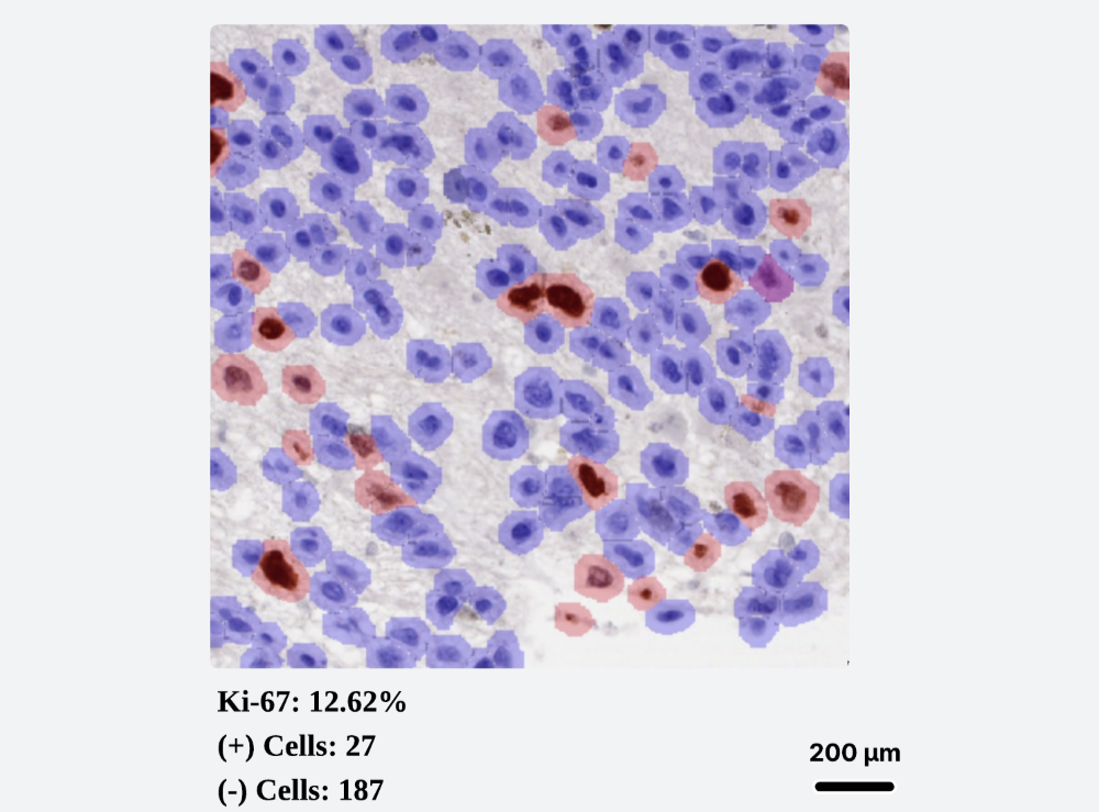 IHC Ki67 quantification screenshot