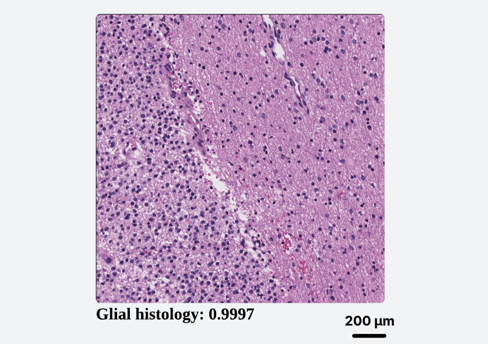 Tumor classification screenshot